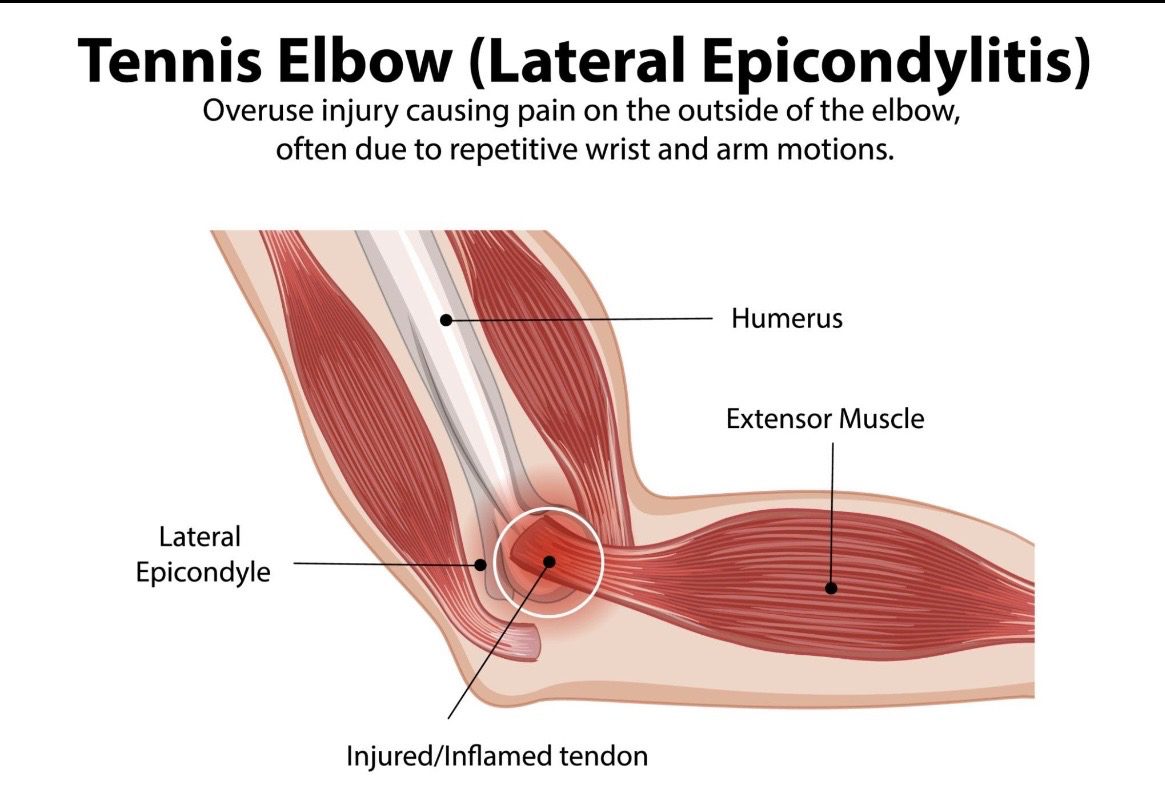 A graphic about Tennis Elbow